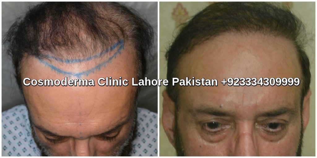 Beard to head hair transplant results in Lahore Pakistan