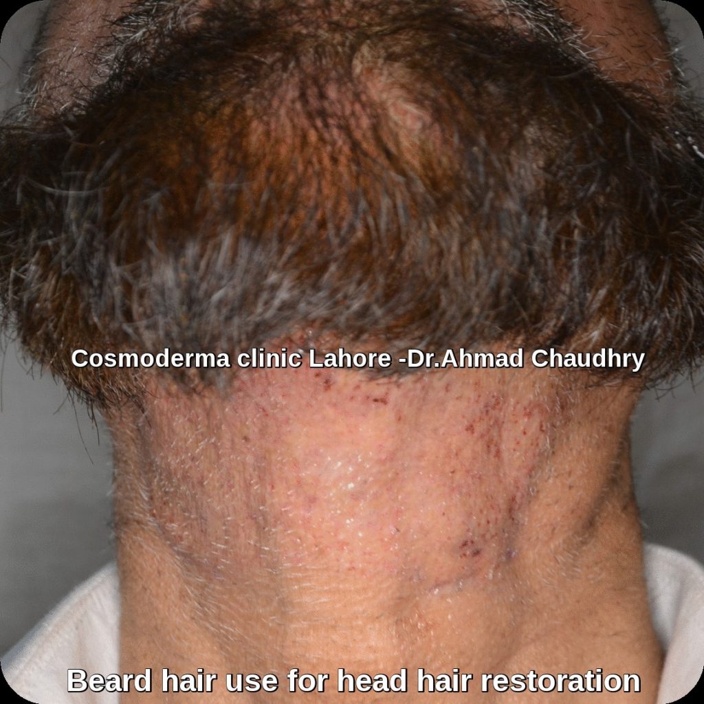 Beard to scalp hair transplant before and after
