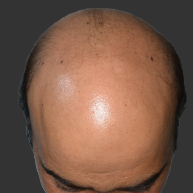 Advance-level-baldness-top-view-before-treatment-Gujranwala-patient