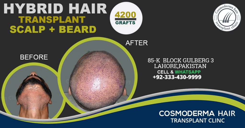 Beard-plus-scalp-donor-hair-to-head-hair-transplant-1