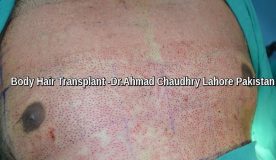 Body_hair_transplant_Lahore_Pakistan