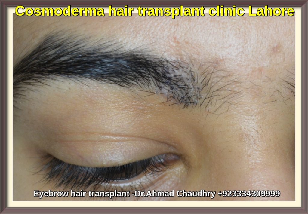 Eyebrow-hair-transplant-in-Lahore-after-procedure