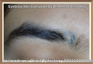 Eyebrow-hair-transplant-surgery-before