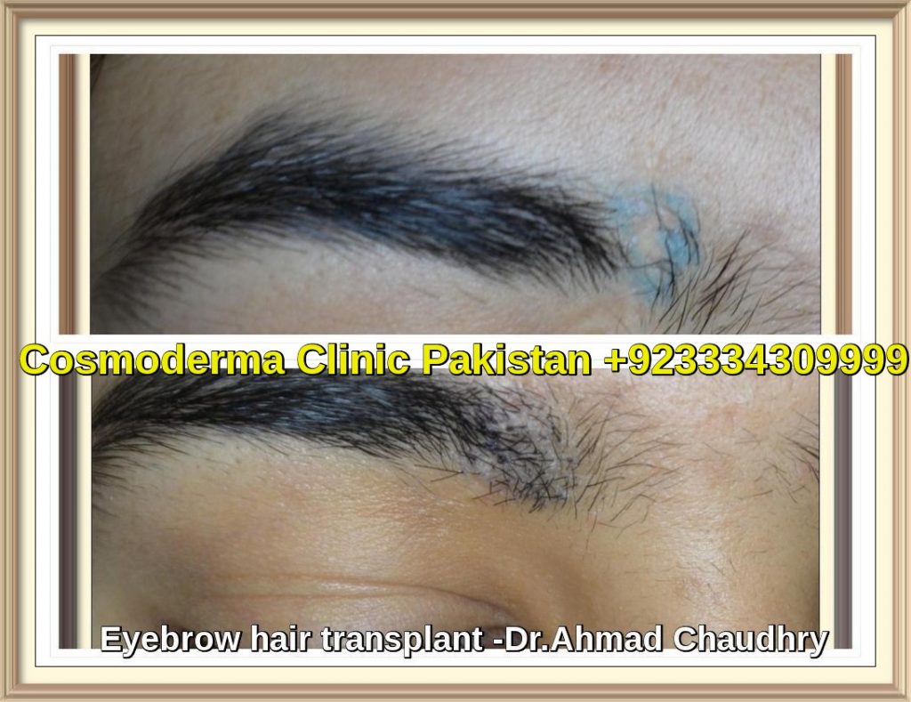 Eyebrow hair restoration Lahore Pakistan 400 Grafts Best FUE clinic