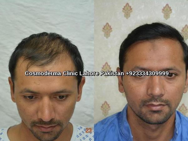 FUE-2800-grafts-results-cosmoderma-clinic-Lahore