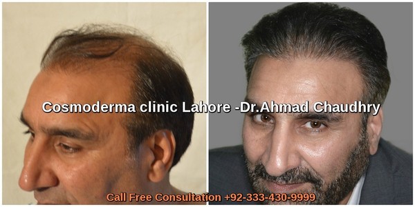 FUE-3000-grafts-results-lahore