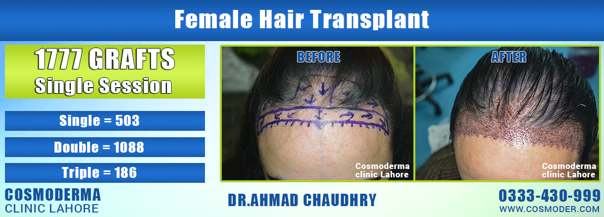 Female-hairline-hair-transplant-in-Lahore