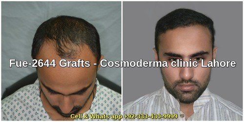 Fue-hair-transplant-results-Lahore