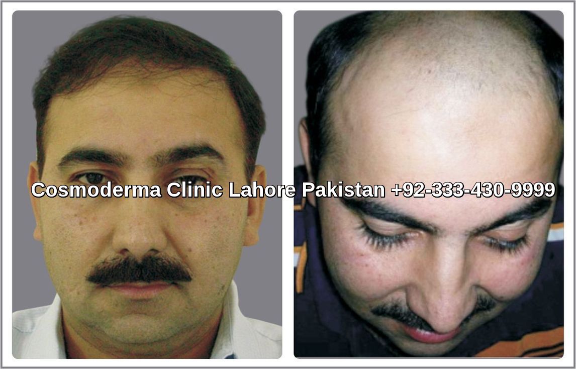 Hair-transplant-before-after-result-Lahore