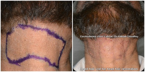 Beard hair transfer to head in Lahore Pakistan | Cosmoderma clinic