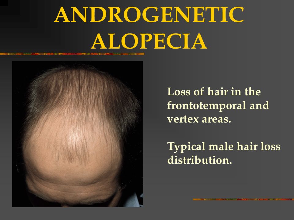 Illnesses that cause hair loss