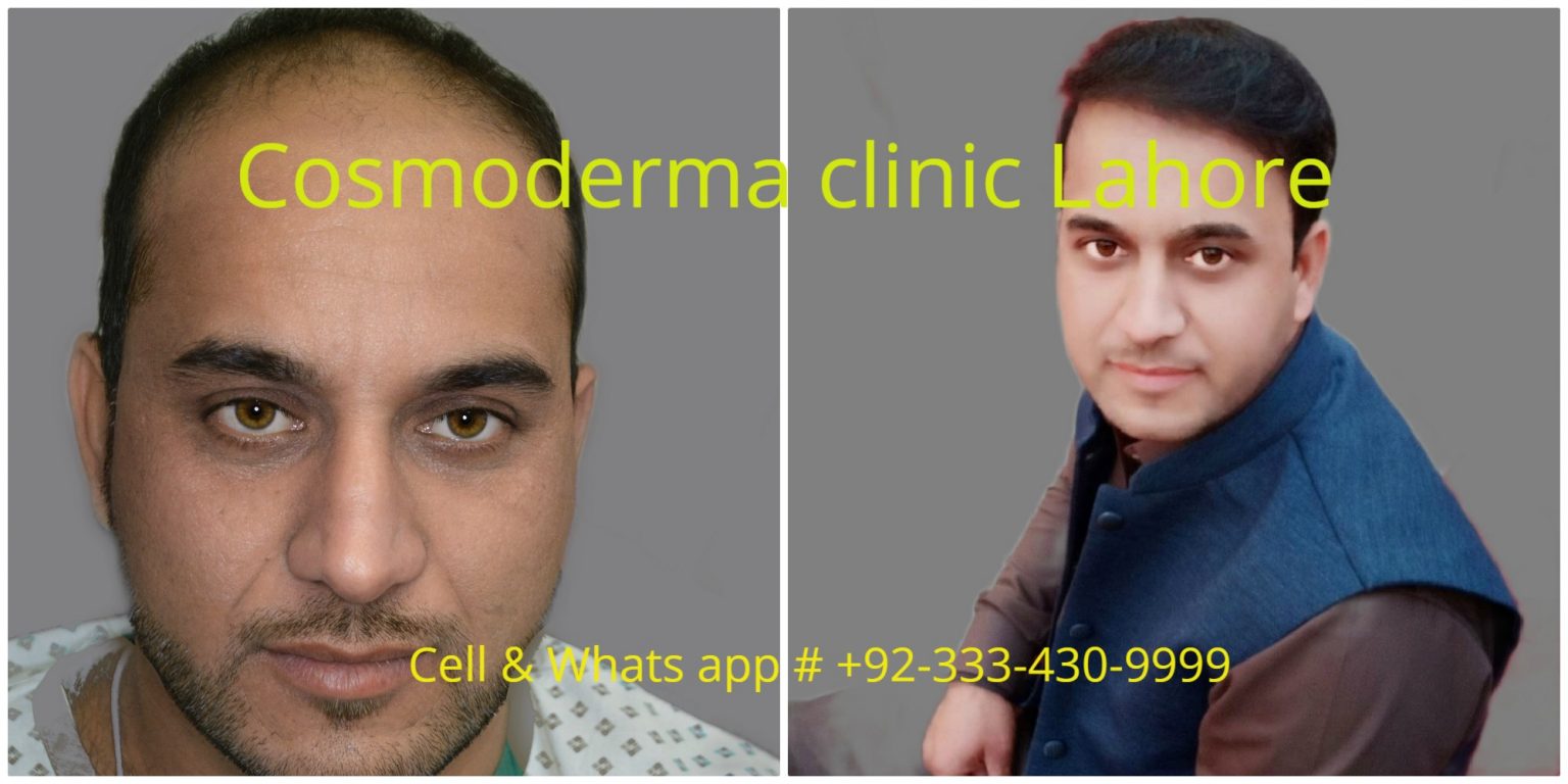 3000 grafts hair transplant Lahore Pakistan Free estimate call us now