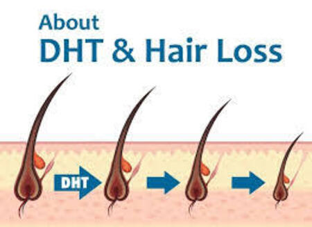 DHT and hair loss