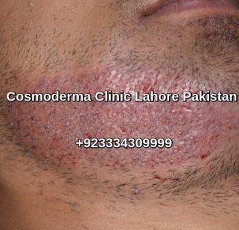 Facial hair restoration Lahore Pakistan