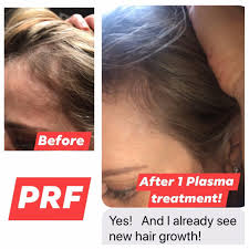 PRF hair loss treatment results Lahore Pakistan