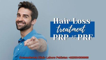 PRF treatment for hair loss