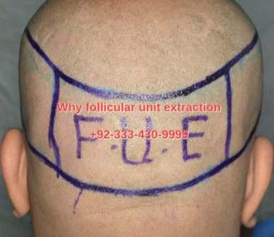 Why follicular unit extraction hair transplant