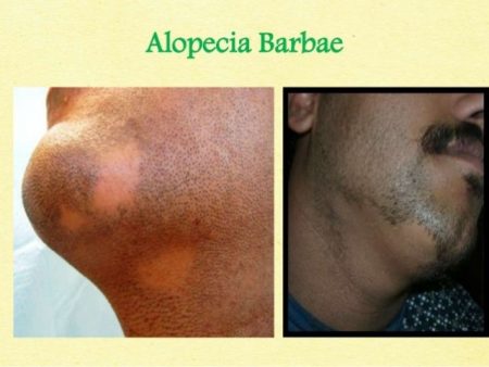 Alopecia barbae- What Causes Beard Hair Loss and treatment Lahore