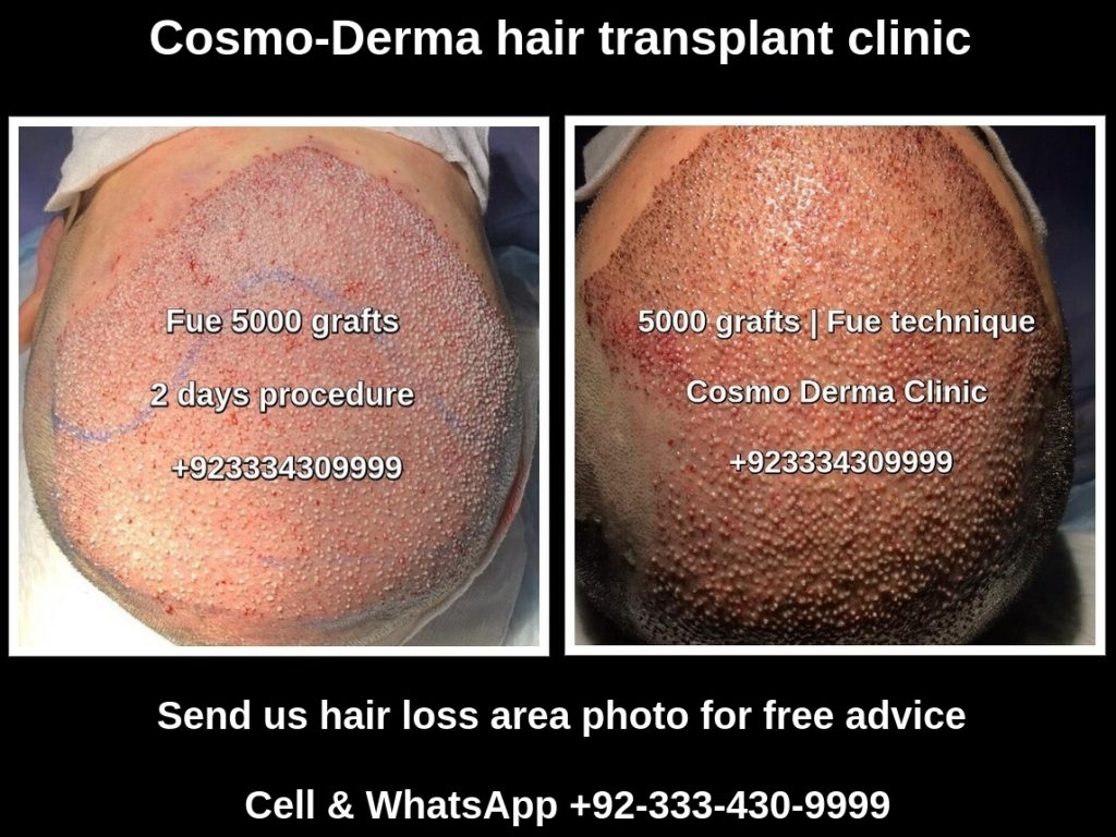 5000 grafts hair transplant cost Lahore