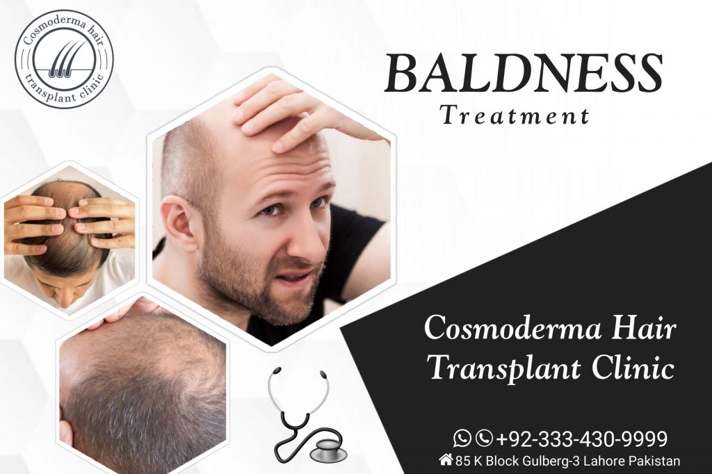 Baldness treatment Lahore Pakistan