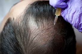Scalp treatment for hair loss Lahore