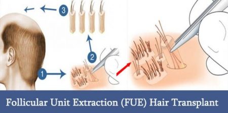 How does hair transplant work? Really amazing results Performed properly
