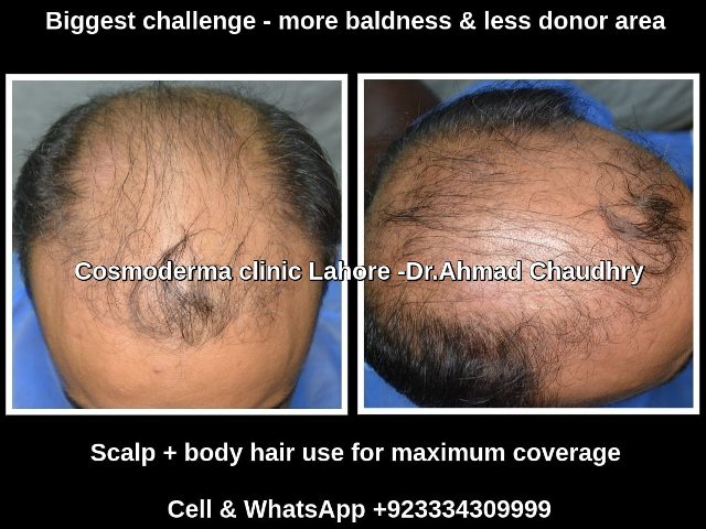 Hair restoration challenges and solution