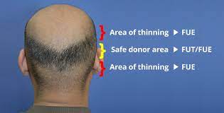 Does fue hair transplant results lifelong