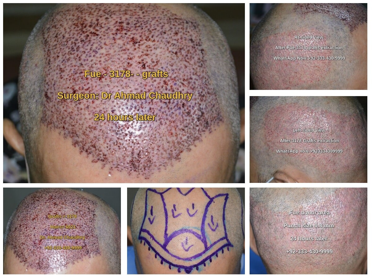 317 grafts before after photos Lahore Pakistan