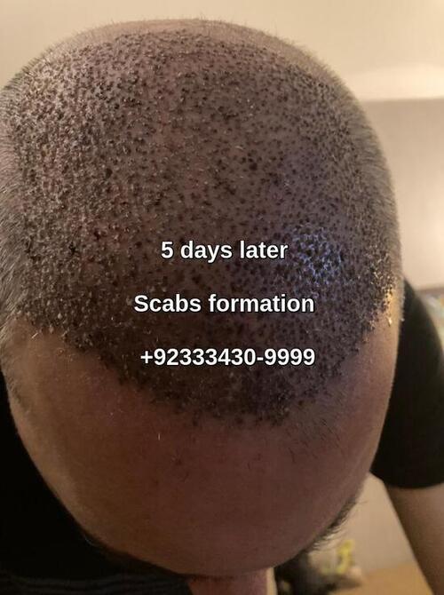 5 days after fue hair transplant procedure