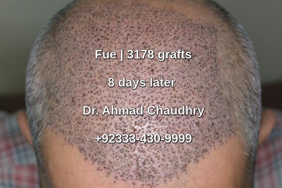 8 days after Fue hair transplant procedure