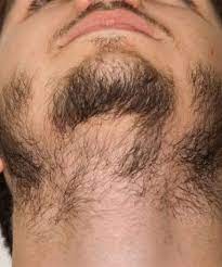 Alopecia areata beard specialist clinic