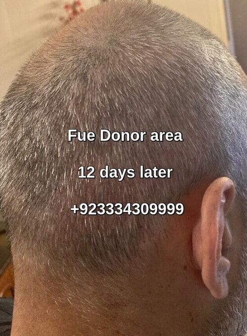 Fue donor area 12 days later