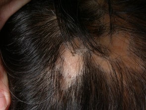Hair disease treatment Lahore