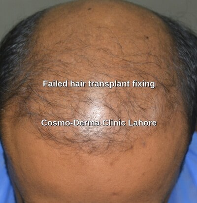 Hair restoration surgery failure
