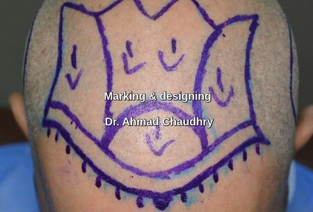 Marking before follicular unit extraction