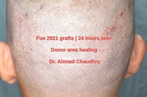 Fue 2921 grafts donor area healing