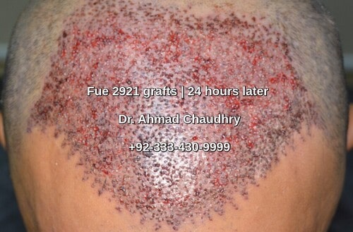 Fue hair transplant-frontal area 2921 grafts