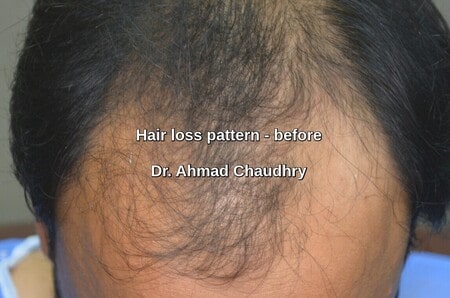 Male pattern baldness Arifwala
