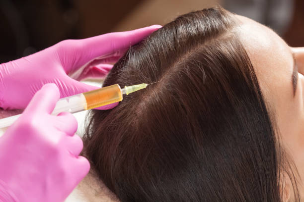 PPR hair loss treatment specialist Lahore
