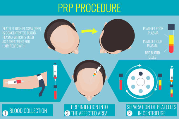 PRP procedure steps