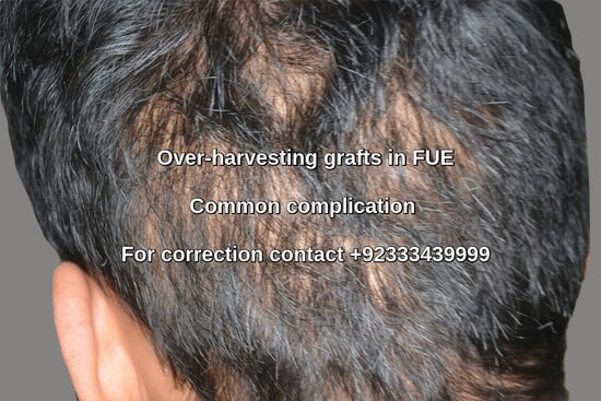 Fue hair transplant complication Lahore Pakistan