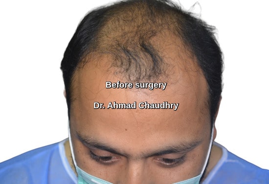 Hair loss Shalimar town patient