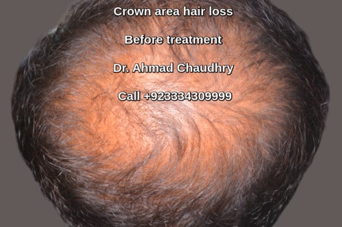 Hair loss before PRP treatment Lahore