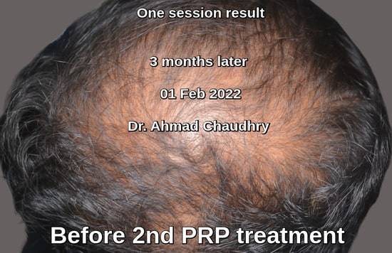 PRP result one treatment Lahore Pakistan
