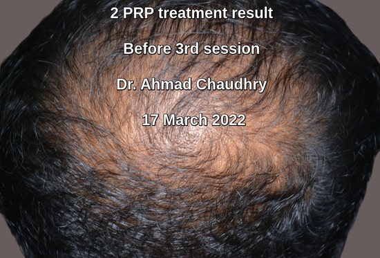 platelet rich plasma two procedure result Lahore