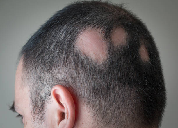 hair restoration for alopecia