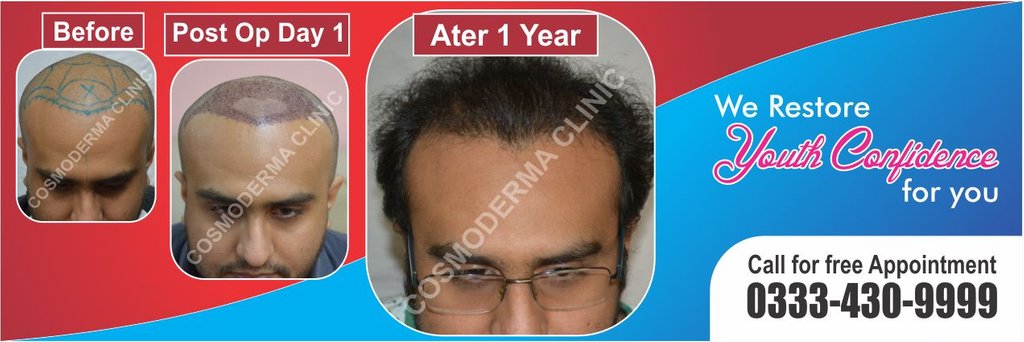 About us hair transplant services Lahore