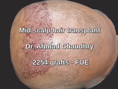 Baldness treatment Abu Dhabi patient abroad