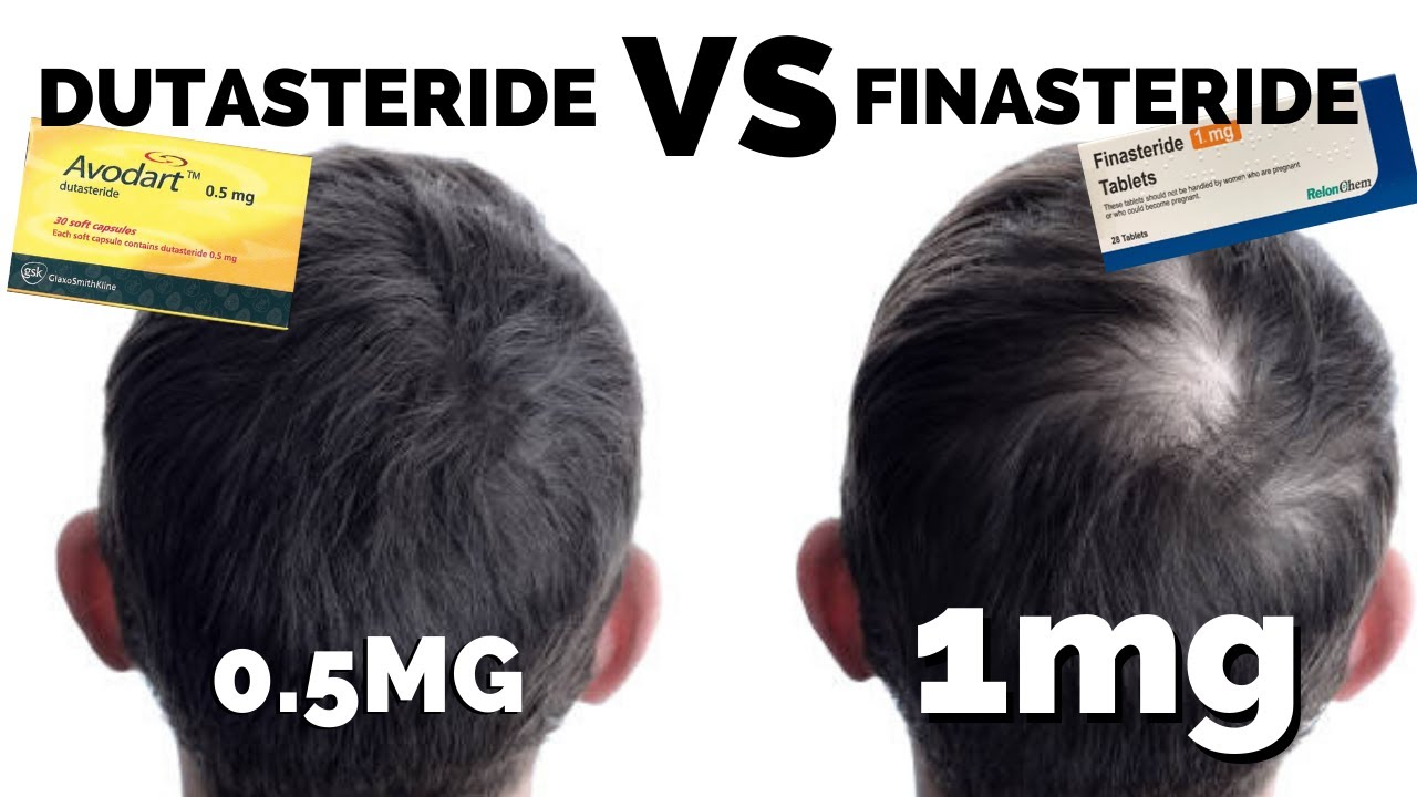 Dutasteride vs Finasteride for hair loss -regrowth treatment Lahore